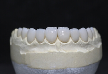 Understanding Tooth Crown Pain: Relief and Treatment Options