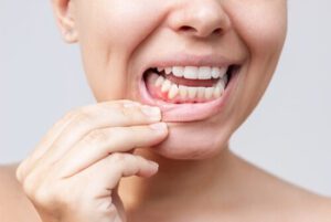 White Gums Around Teeth causes