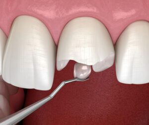 Types of Dental Fillings cost