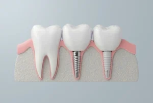 how to relieve pain from dental implant procedure