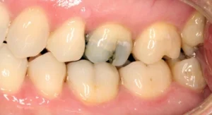 Are Chipped Teeth Common crack Are Chipped Teeth Common crack