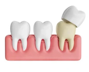 What Is a Tooth Filling crown What Is a Tooth Filling crown