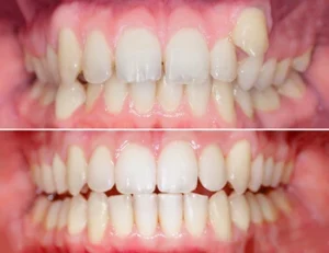 before and after effects of orthodontic procedure before and after effects of orthodontic procedure
