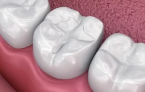 How Long Does Composite Bonding Last colour How Long Does Composite Bonding Last colour