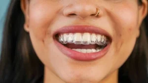 Types Of Dental Braces invisalign Types Of Dental Braces invisalign