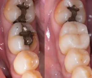 Temporary Tooth Filling replacement Temporary Tooth Filling replacement