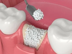 what is a bone graft procedure what is a bone graft procedure