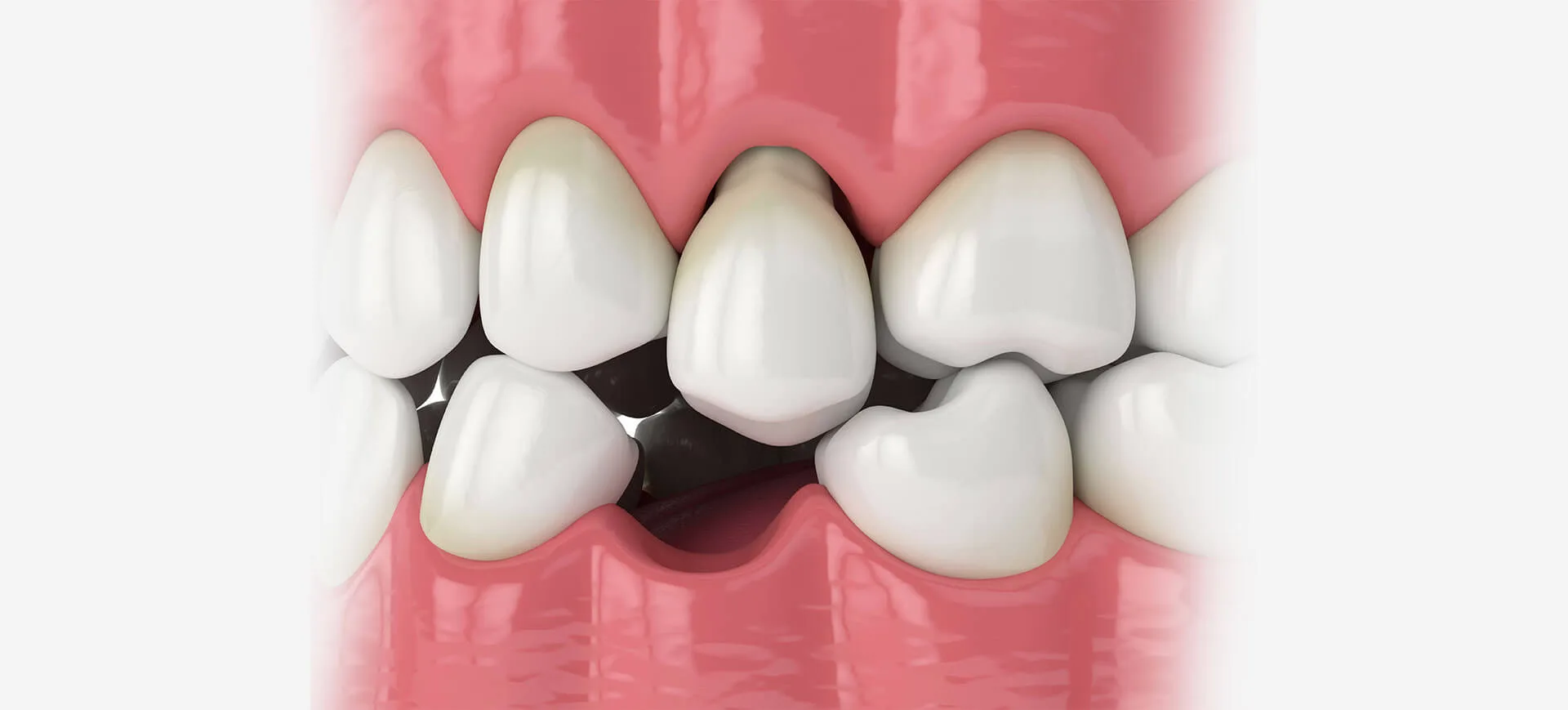 Why-are-back-teeth-more-important Why are back teeth more important
