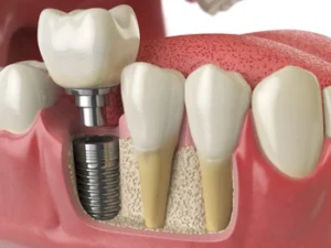 before after photo of a patients smile showing the replacement of a missing front tooth with a natural looking implant crown before after photo of a patients smile showing the replacement of a missing front tooth with a natural looking implant crown