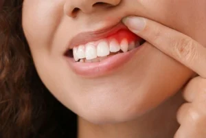 gum redness and swelling on a woman gum redness and swelling on a woman