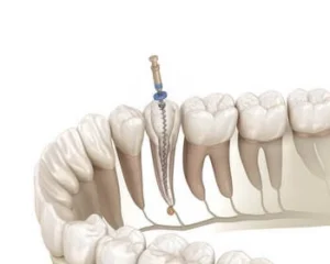 how root canal works how root canal works